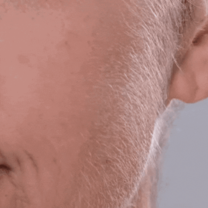 Elycura™: Feel Confident Again. Gentle Hair Removal for Hormonal Skin